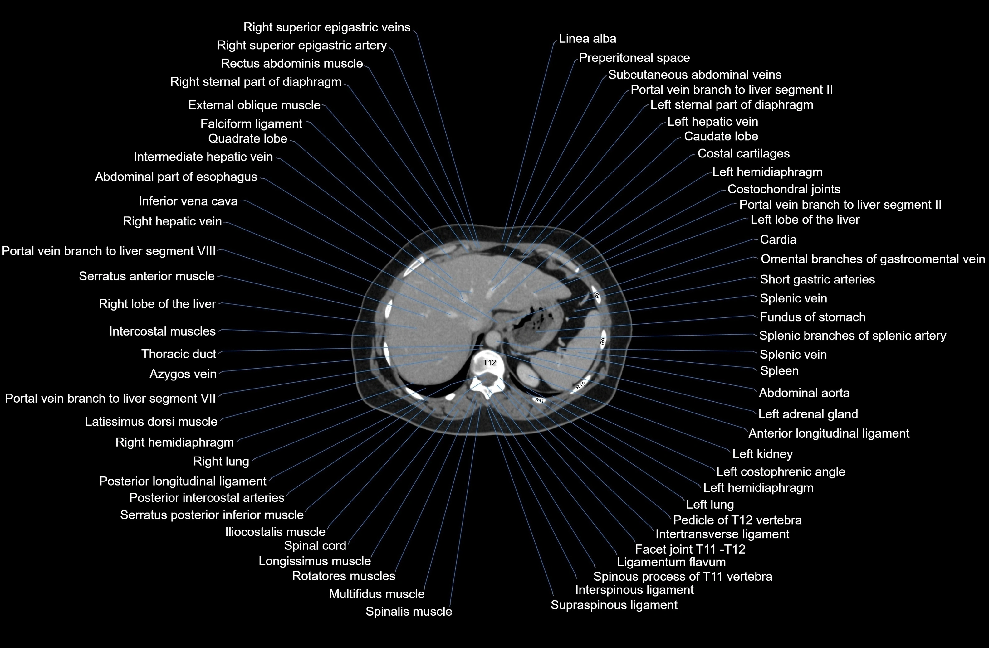CT Abdomen axial cross sectional anatomy labelled radiology image-00015.webp